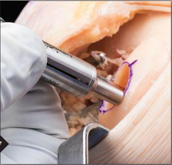 Depth markings on the reamer allow surgeon to drill to