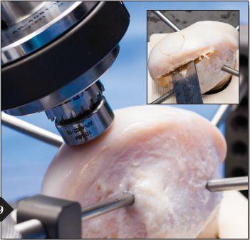 Current OCA Transplantation Procedure Allograft harvested from cadaver