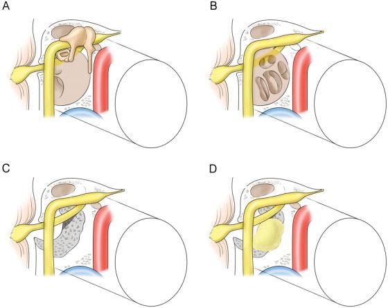 84 Endoscopic Transcanal Acoustic Tumor Removal Moon et al. Fig. 1 Schematic representation of the modified exclusive endoscopic transcanal transpromontorial approach (EETTA).