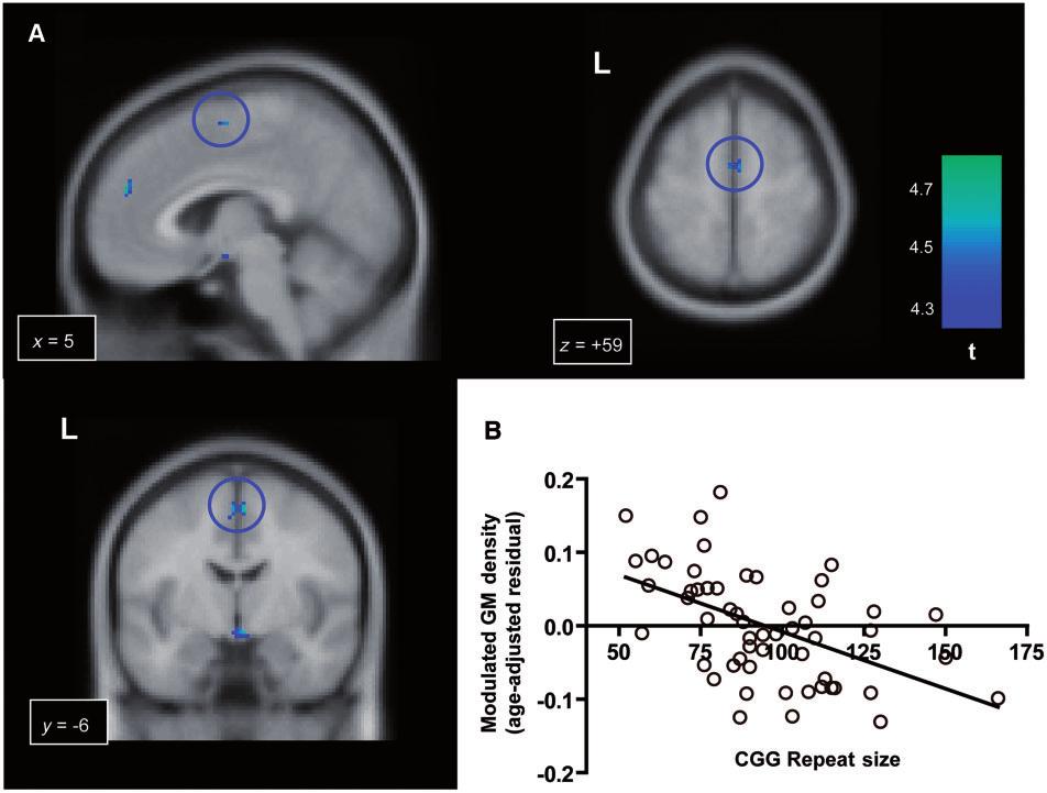 Grey matter abnormalities in FXTAS Brain 2011: 134; 863 878 873 Figure 4 Significant negative effect of the CGG repeat size on the grey matter (GM) density in the FMR1 premutation carriers.