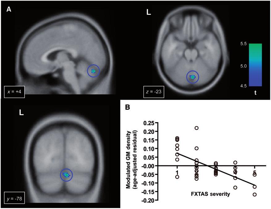 874 Brain 2011: 134; 863 878 R.-i. Hashimoto et al. Figure 5 Progressive grey matter (GM) loss correlated with the severity of FXTAS.