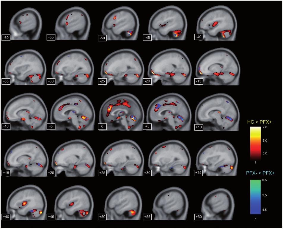 Grey matter abnormalities in FXTAS Brain 2011: 134; 863 878 867 Figure 1 Significant grey matter reduction of FXTAS (PFX + ) identified by comparison either with healthy controls (HC) or with