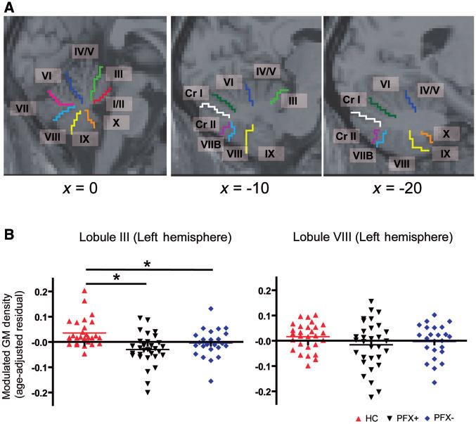 Grey matter abnormalities in FXTAS Brain 2011: 134; 863 878 871 Figure 2 Region of interest analyses of the cerebellar subregions.