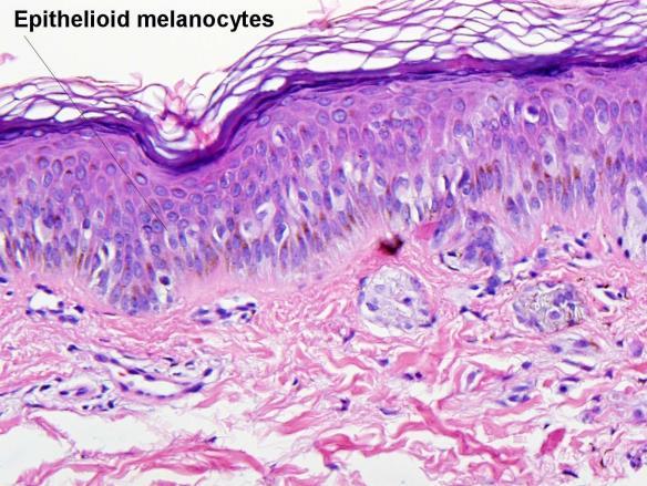 in a child Pagetoid Intraepidermal Spitz Nevus Pagetoid scatter of epithelioid melanocytes Small Sharply circumscribed End laterally in a