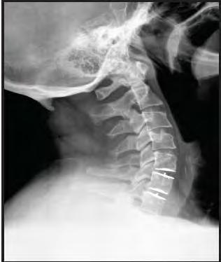 The challengers Two-level cervical disc arthroplasty Compared to fusion: Improved Patient Reported