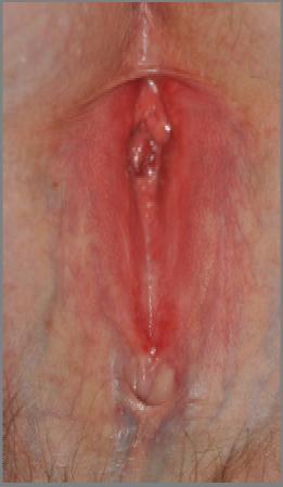 estrogen (topical or vaginal) for postmenopausal