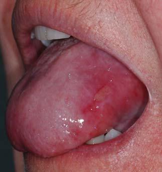 Oral and Vulvovaginal Lichen Planus
