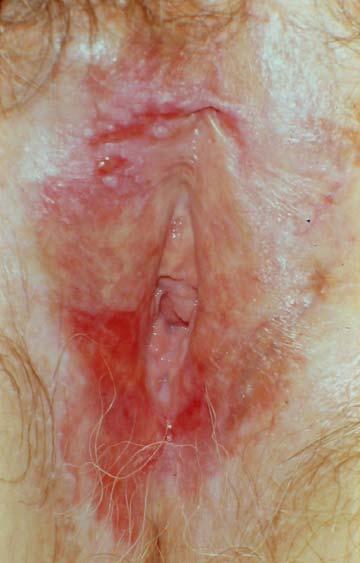 Biopsy LS + dvin III Re-biopsy Vulvar SCC 30-40% vulvar SCC occur in lichen sclerosus Lichen sclerosus and