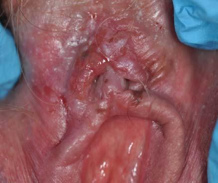 74 year old with burning and itching on clitoris for 10-12 months no response to