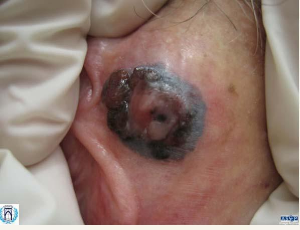 Underlying local carcinoma - in 20% - 25% of vulvar EMP Itching, soreness,