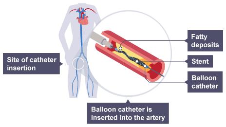 This has the effect of narrowing the lumen of the artery, reducing the amount of oxygenated blood that can be supplied to the heart muscle.