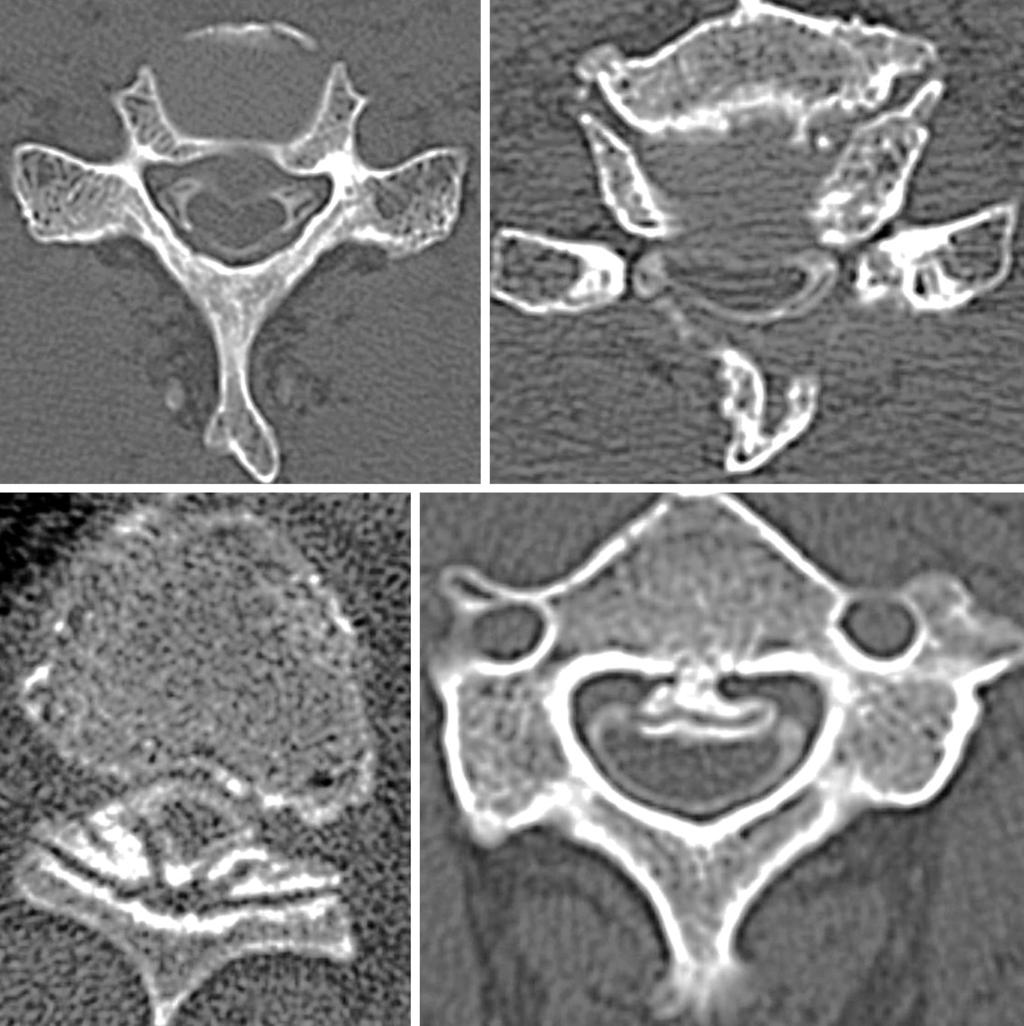 20 Masashi Miyazaki et al. Asian Spine J 2014;8(1):19-26 are few reports on the compressive lesions of the spinal cord at the cervical or thoracic level in lumbar degenerative disease.