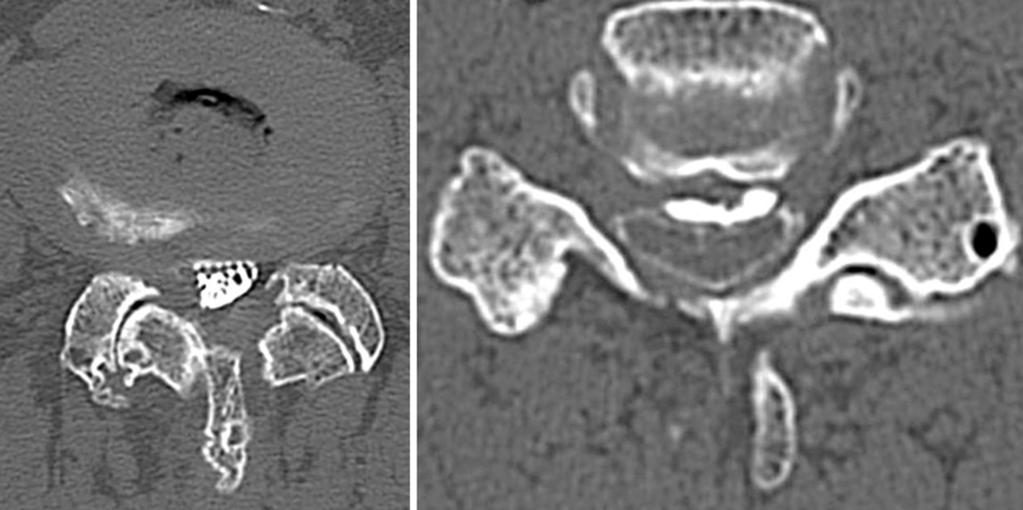 24 Masashi Miyazaki et al. Asian Spine J 2014;8(1):19-26 Magnetic resonance imaging (MRI) of the lumbar spine revealed stenotic changes at the L3 4 level.