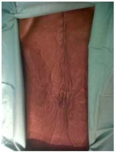 Figure 2 Picture showing marked wasting and the previous midline open- cholecystectomy scar CASE REPORT Mrs AO, a 62-year-old female presented in the surgical outpatient department of the University