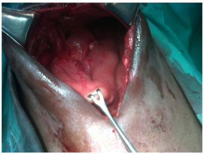 Figure 6 Figure 4 Prophylactic gastrojejunostomy done Markedly dilated stomach after adhesiolysis was done.