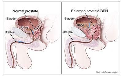What is Benign Prostatic Hyperplasia (BPH)? Benign prostatic hyperplasia (BPH) is an enlarged prostate. The prostate goes through two main growth periods as a man ages.