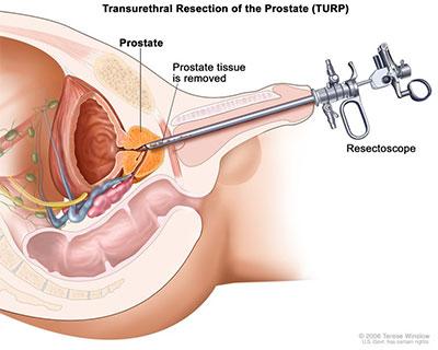 What is Transurethral Resection of the Prostate (TURP)? Transurethral Resection of the Prostate (TURP) is the most common surgery for BPH. In the United States, about 150,000 men have TURPs each year.