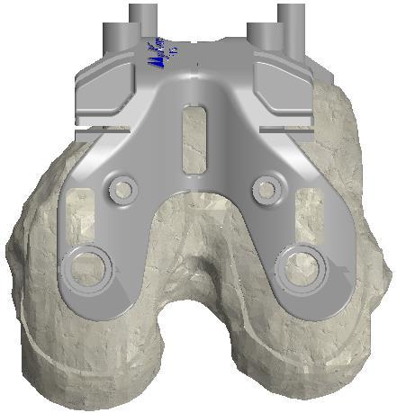 The 3D femoral bone model allows for an accurate simulation of the position of the MyKnee femoral PPS block.