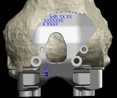 TIP The telescopic alignment rod can be used to check the proper positioning of the MyKnee femoral PPS block on the bone.
