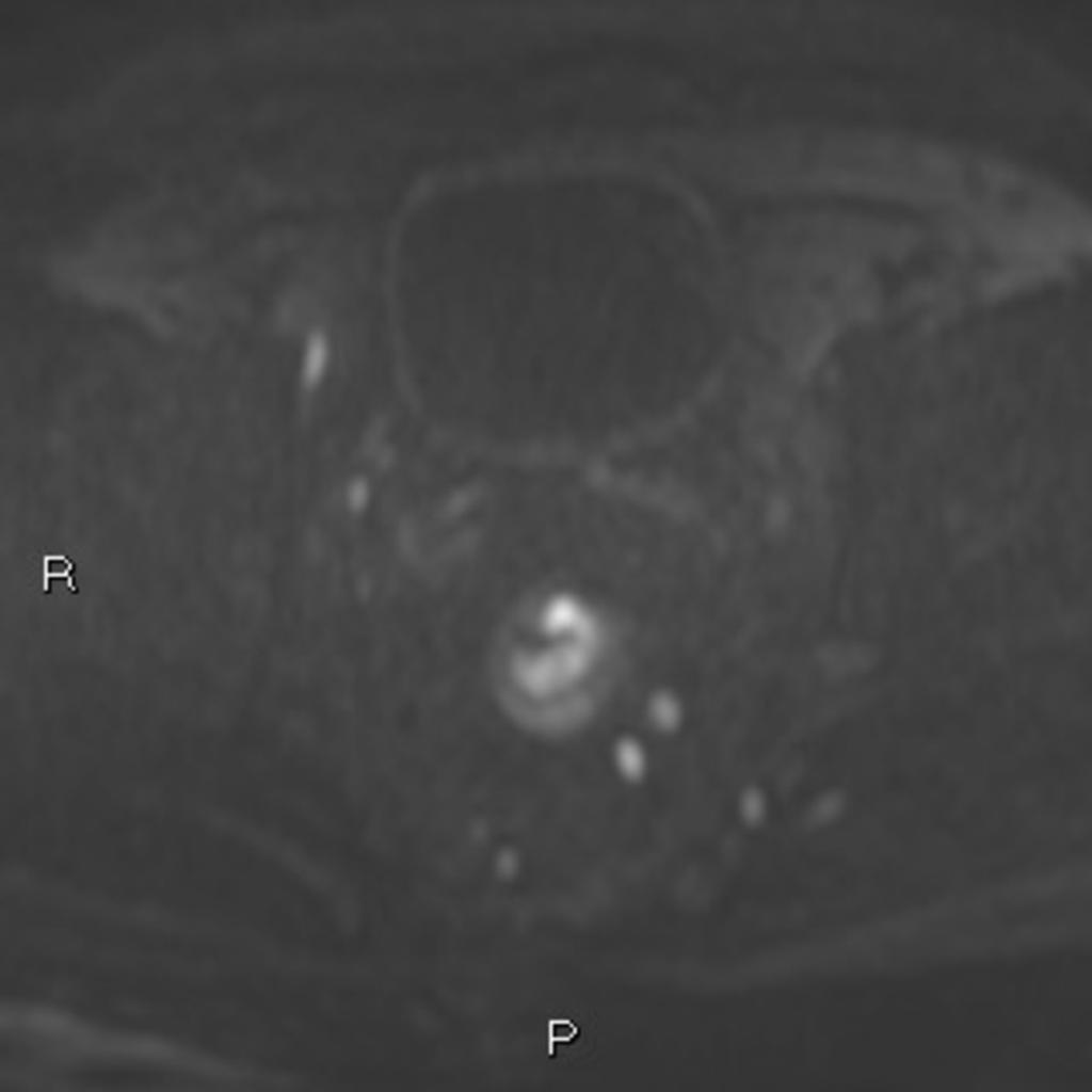 Fig. 6: Case 2: DWI shows tumor an