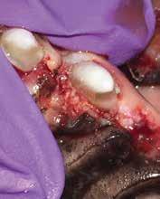 Many cases have significant bone loss requiring grafts and/or membranes to facilitate appropriate healing.
