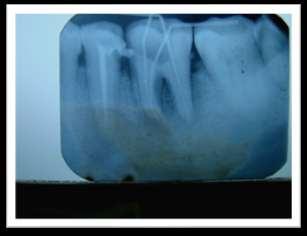 INTRODUCTION Periapical infection usually occurs as a consequence of caries, periodontal disease, operative dental procedures or trauma.