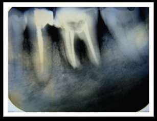 In recent times, fewer patients need periapical surgery.