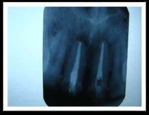 conservative dentistry & endodontics, with broken tooth