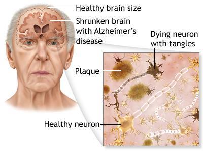 degenerative diseases like Alzheimer's dementia, Parkinson s disease and Multiple
