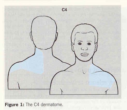 Pain Referred from the Shoulder Mostly C5 dermatome :
