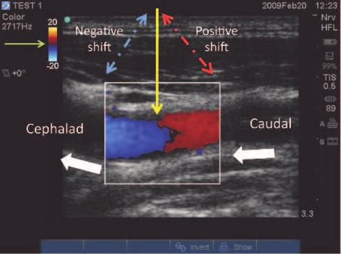 jugular vein (IJV), common carotid artery (CCA), and thyroid gland. The image on the right shows the same structures imaged with a lower frequency (4-MHz) transducer.