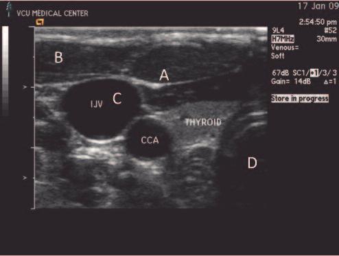 flat, smooth surface of the fascia. Diffuse reflection occurs in muscle tissue (B) where the many small surfaces created by cell junctions causes the ultrasound beam to return in various directions.