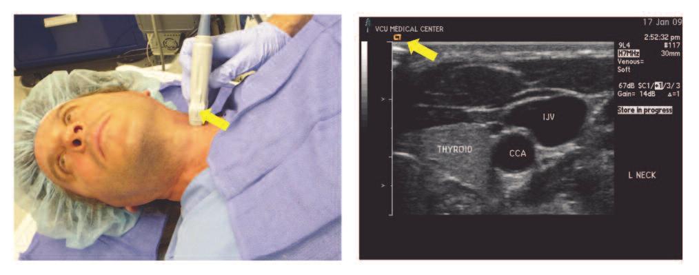 (indicated by the yellow arrows). CCA indicates common carotid artery; IJV, internal jugular vein. Figure 10.