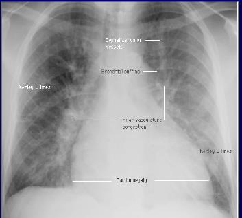 CXR in AHF Misses cadiomegaly in 20% of echo proven cardiomegaly.