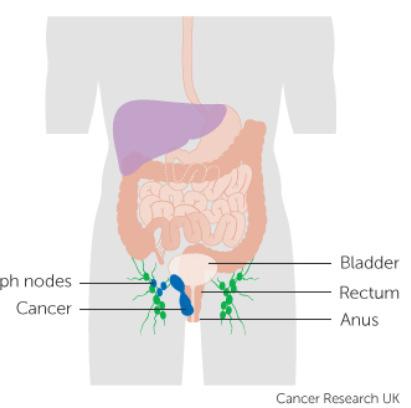 Anal cancer T1 T2 T3 T4 <2cm >2cm-5cm >5cm Any size /other organs N1 perirectal
