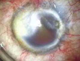 Scars PTK Trypan blue 0.01%. Work at the transparent side of cornea Mydriasis (>7) Hooks?