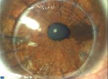 Combined Keratoplasty and Cataract Combined Biometry Ave Keratometry Rejection 14-31% PC Rupture Vitreous Visability Paraxial illumination