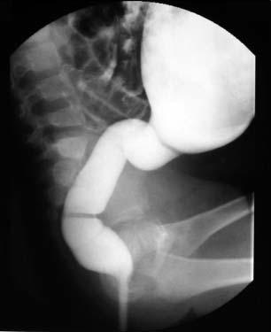 upper colon; (C): in this case the aganglionotic segment is extented up to the splenic flexure C It is the first series operated in our country using this procedure.