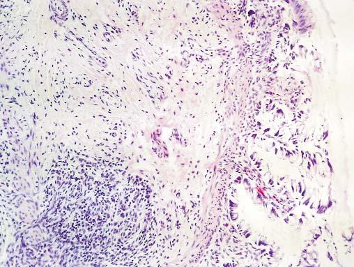 211 Figure 3. (): fragment of colonic mucosa and submucosa note the absence of ganglionic cells from Meissner plexus (hematoxylin and eosin stain, Ob.