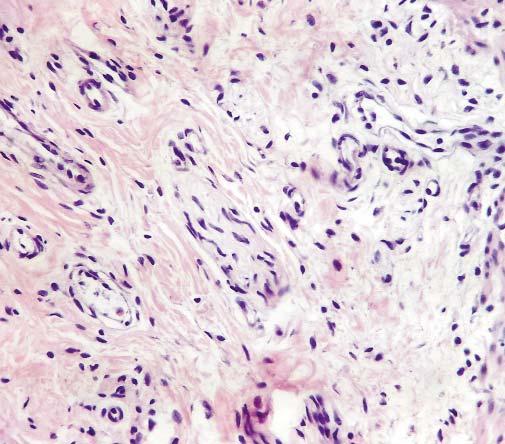 (): the absence of ganglionic cells in both the muscular and submucous plexuses (hematoxylin and eosin stain, Ob.10X); (): detail of previous picture (Ob.