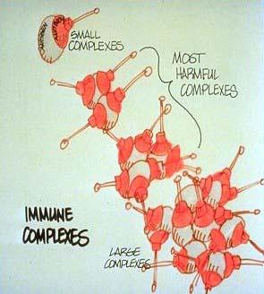 Immune Complex Disease 1. Antibody and antigen combine to form a complex. 2.