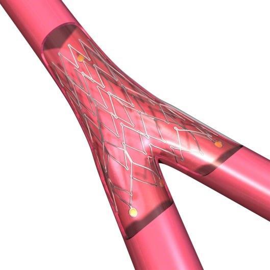 The Axxess Stent: A dedicated bifurcation DES Nitinol self-expanding stent Conical shape Abluminal biodegradable PLA polymer/ Biolimus BA9 coating technology Delivers over