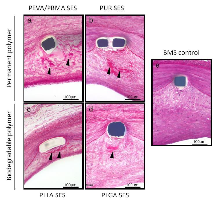 BMS vs. Durable vs. Biodegradable Polymer-coated DES in Porcine Coronary Model (28-days) 4 3 2 1 Neointimal Area p = n.s. BMS PEVA/PBMA SES PUR SES PLLA SES Inflammation Score PLGA SES 3 2 p =.