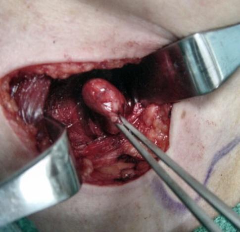 Fig 9 Left parathyroid adenoma excision with medial retraction of thyroid gland.