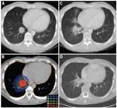 2% (IB) Timmerman et al, JAMA, 2010 38 patients with 63 lesions 48 60 Gy in 3 fractions SBRT for Lung Mets 57 NSCLC patients 45 Gy in 3 fractions 3 year Local Control 92% 88%