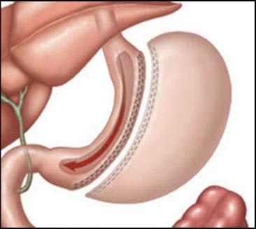 What is the sleeve gastrectomy? Restrictive procedure. It involves removing 80% of the stomach, leaving a long, narrow banana-shaped stomach behind.
