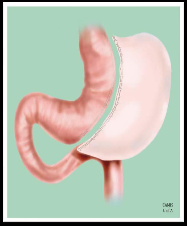 Laparoscopic Sleeve Gastrectomy Gastric Sleeve Pylorus Excised Stomach The surgeon uses surgical staples to create a