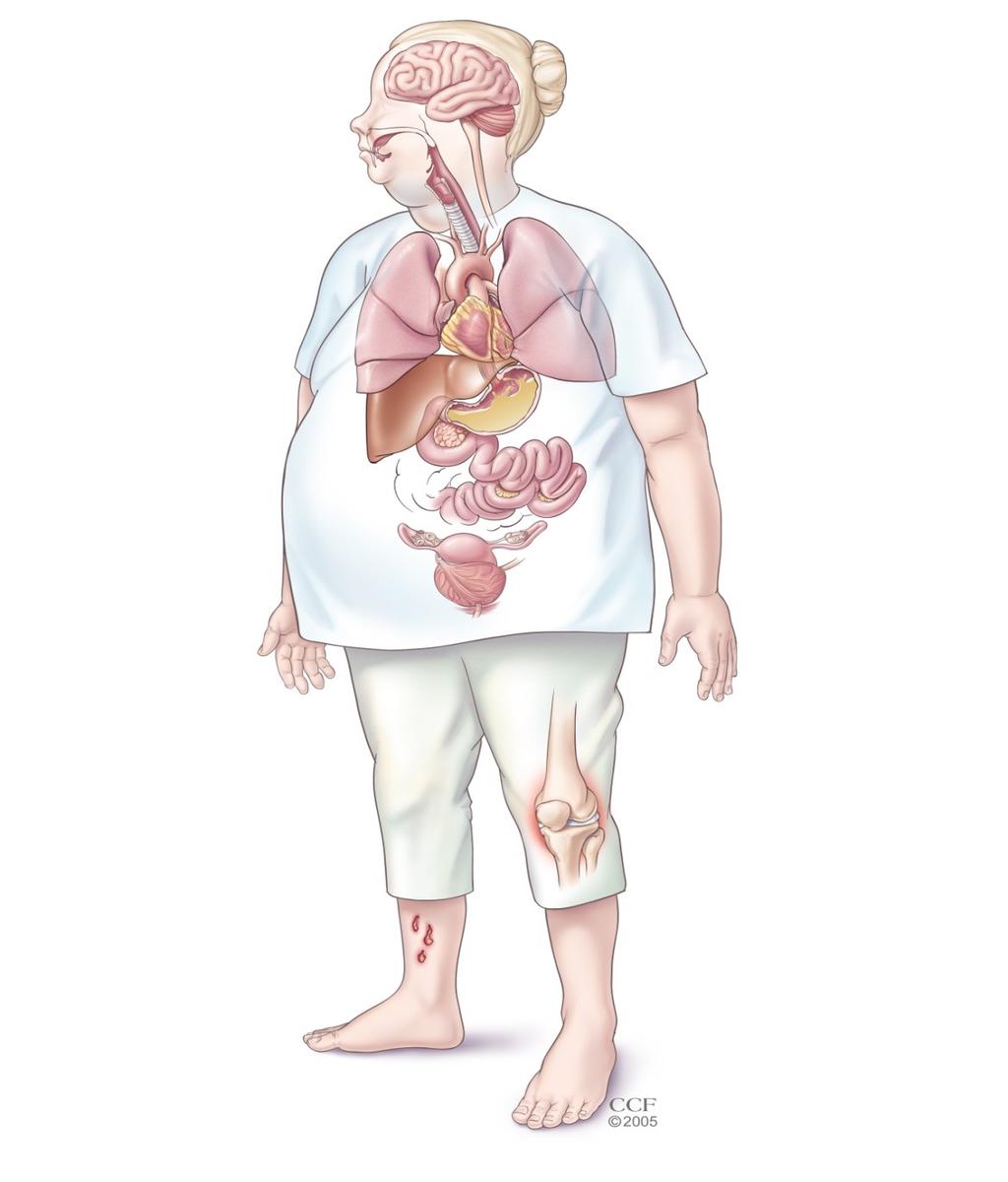 Obesity-related Disease The Harmful Effects of Obesity Migraines Sleep apnea Asthma Increased chance of developing one of these and/or additional diseases: Liver disease