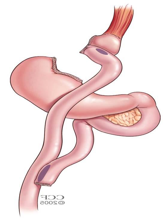 Primary Metabolic and Bariatric Procedures Laparoscopic Gastric Bypass Stomach reduced to size of walnut, attached to jejunum, thereby bypassing a portion of small intestine