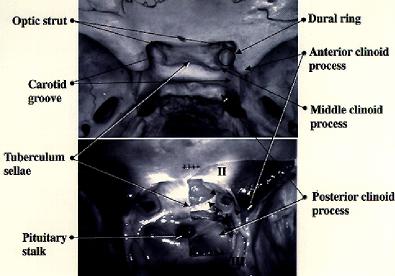Fig. 3. Photographs presenting superior views of the juxtadural ring area in cadaver specimens, showing the relationship of bone and dural structures.
